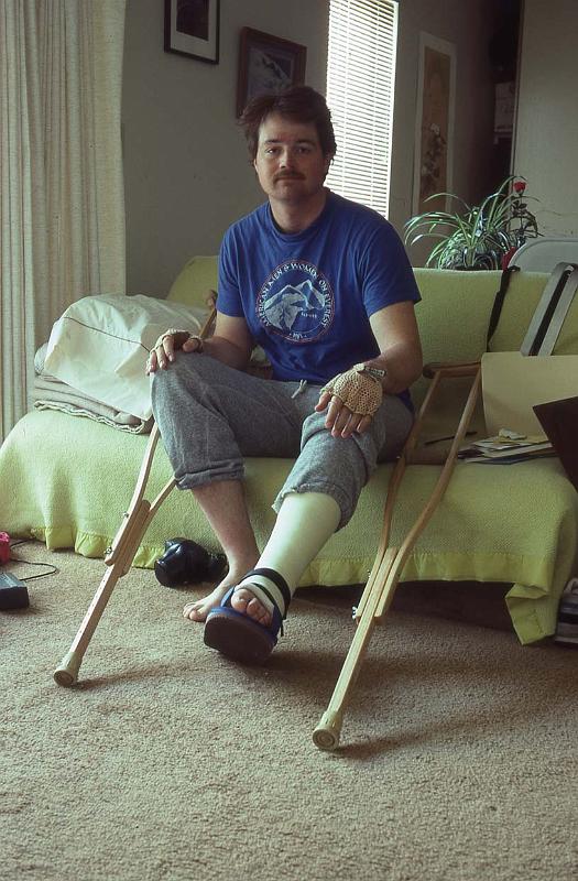 1985-015 Mt Shuksan May 1985 Me with Leg Cast.jpg